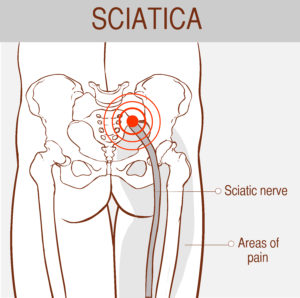 sciatic nerve pain pregnancy